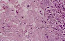科普下尿液上皮细胞检测的临床意义是什么