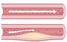 科普下HDL与动脉粥样硬化的联系