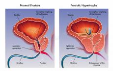 男性对前列腺癌的了解需要改善