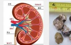 研究揭示了与肾结石相关的新遗传因素