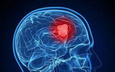 研究人员在脑癌的药物反应与细胞变化之间发现意外关联