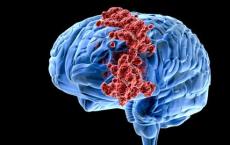 研究揭示了有关脑癌如何传播的新信息
