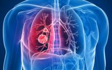 研究人员确定了肺纤维化的新治疗靶标