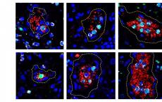 过度活跃的嗜中性粒细胞可能会驱动某些新型肺炎患者发生