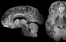 新的多机构研究确定了新型肺炎患者脑部MRI异常表现的模式