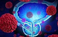 科学家已经发现与前列腺癌扩散或形成转移有关的转换