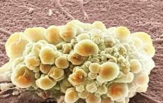 免疫系统细胞促进胶质母细胞瘤的侵袭能力