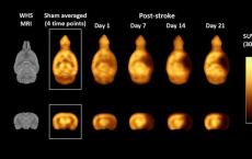 新型放射性示踪剂可测量中风后的突触活动