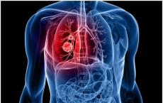 非吸烟者的肺癌对治疗的反应可能不同