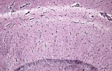 小胶质细胞与进行性MS的脑萎缩有关