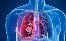 Moffitt研究人员发现特定组蛋白脱乙酰基酶在肺癌中的新作用