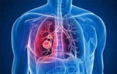 自身抗体检测和CT成像可以降低肺癌死亡率