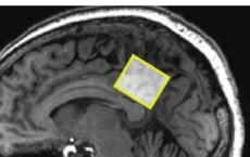 新的研究扫描了显示大脑区域的MRI