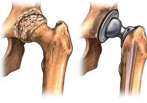 全踝关节置换术为患者提供更大范围的运动和更少的疼痛