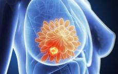 分子开关可能使乳腺癌对免疫治疗敏感