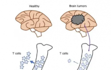 脑癌可通过在骨髓中捕获T细胞来抵抗免疫治疗