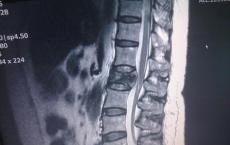 SUTD和合作者开发了新颖的方法来预测患者的脊柱骨折