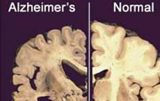 治疗可减少阿尔茨海默氏症的损害