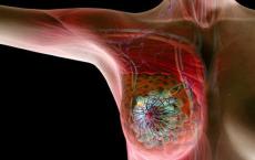 延长的来曲唑疗法可改善HR+乳腺癌的绝经后妇女的无病生存