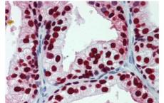过度活跃的FOXA1重编程内分泌抗性乳腺癌使其转移