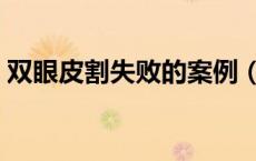 双眼皮割失败的案例（双眼皮手术失败案例）